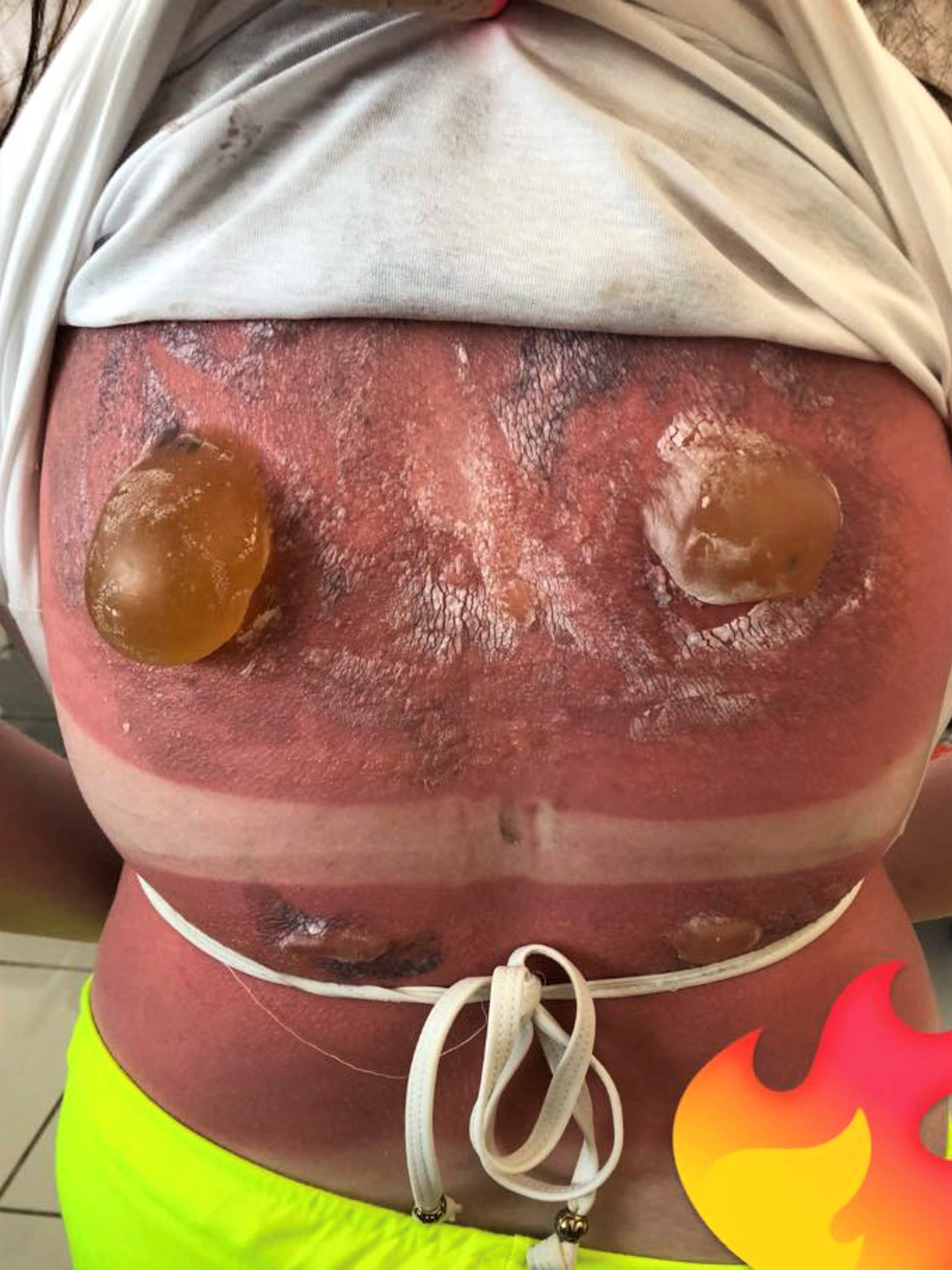 Maisie Severe Sunburn Blisters on Back