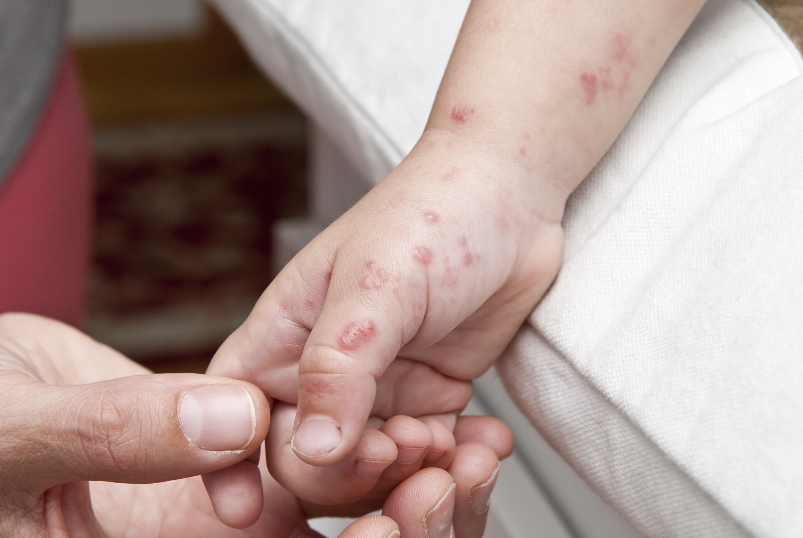 Child With Blisters Hands